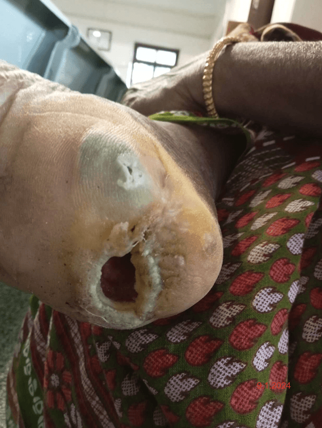 Clinical image from a chronic heel-ulcer case study